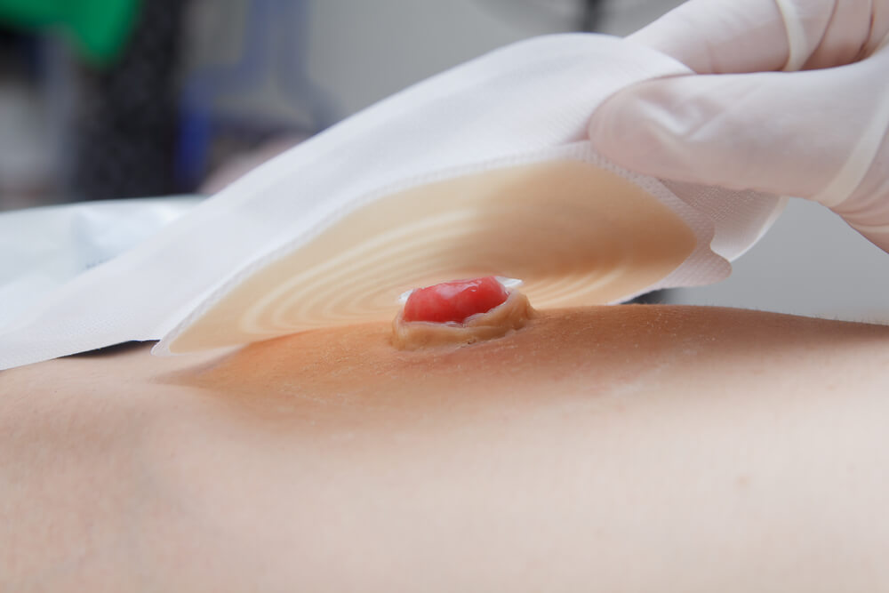 Stoma